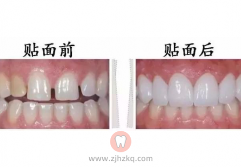 杭州瓷贴面哪家强瓷贴面能修复哪些问题牙