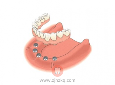 哪些人适合做半口种植牙/全口种植牙