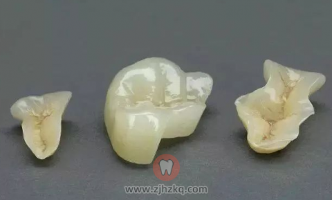 杭州做嵌体牙多少钱一颗