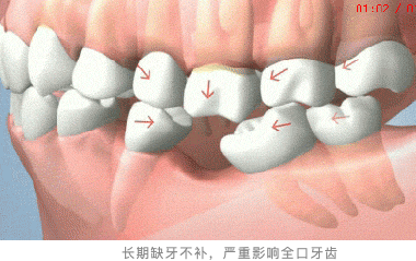 长期缺牙不补危害实在是太大了