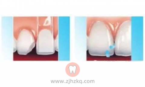 补牙后可以保留多久