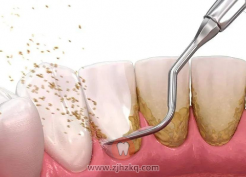 并非所有人都适合洗牙这5种人不能洗