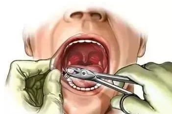 拔牙后会不会发烧