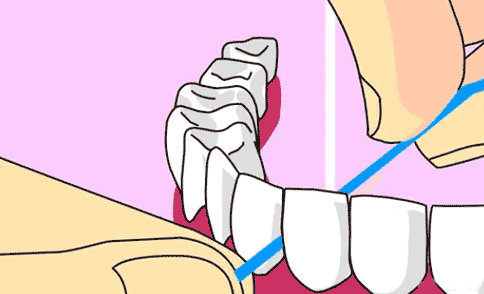 塞牙怎么办一般牙科怎么处理