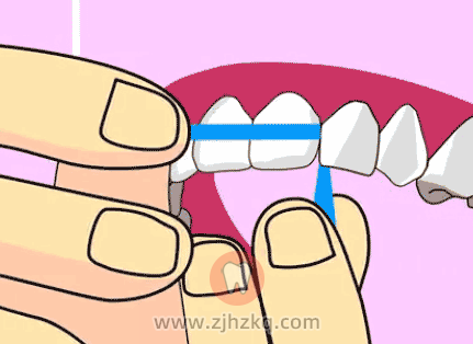 塞牙怎么办一般牙科怎么处理