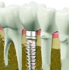 杭州做种植牙好还是做假牙好