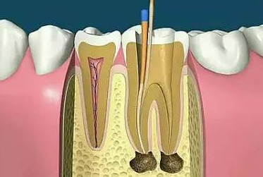 根管治疗为什么要分好几次