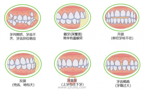 如何预防孩子牙齿畸形