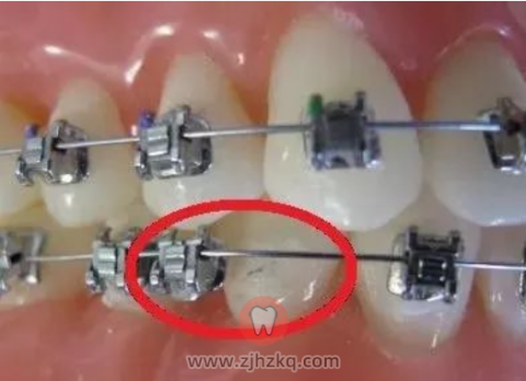 疫情期间牙齿矫正出现问题怎么办攻略来了