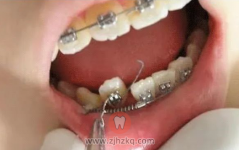 什么是牙齿矫正？注意事项有哪些