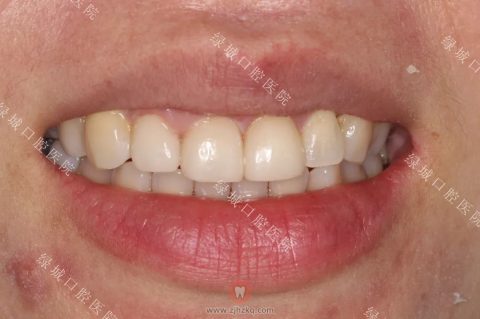 杭州绿城牙医教你如何美白牙齿