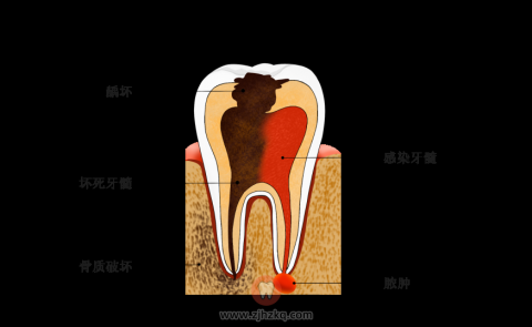 哪些情况下需要根管治疗