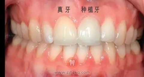 种植牙和真牙对比照片