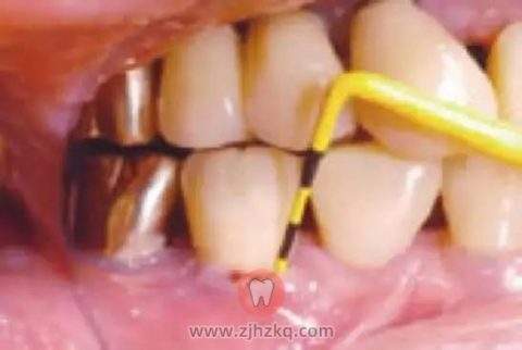 种植牙要定期找牙科医生进行专业护理