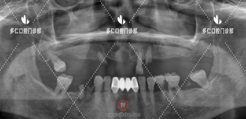 杭州多仁口腔无痛微创半口种植牙看牙记