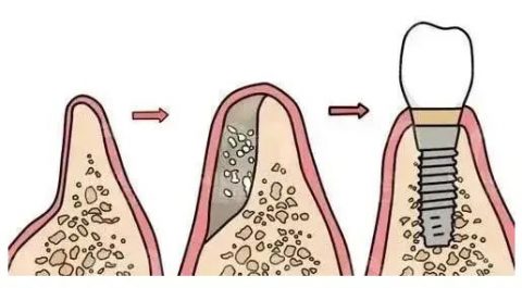哪些情况会导致牙槽骨吸收