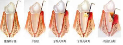 牙周病对种植牙究竟有哪些危害