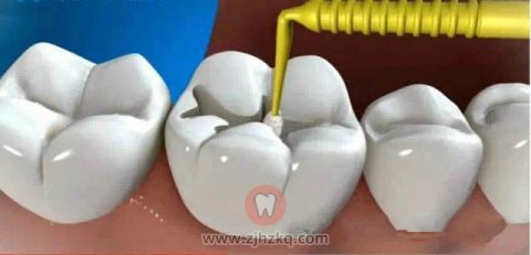 杭州补牙哪种材料性价比高