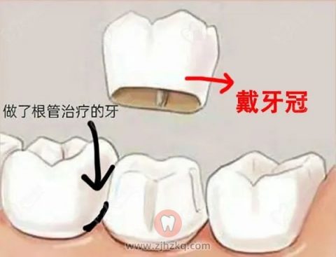 杭州根管治疗全瓷牙冠烤瓷牙冠价格表最新版