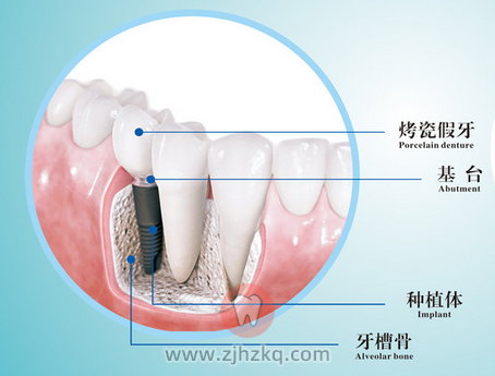 缺牙要选种植牙的三个理由