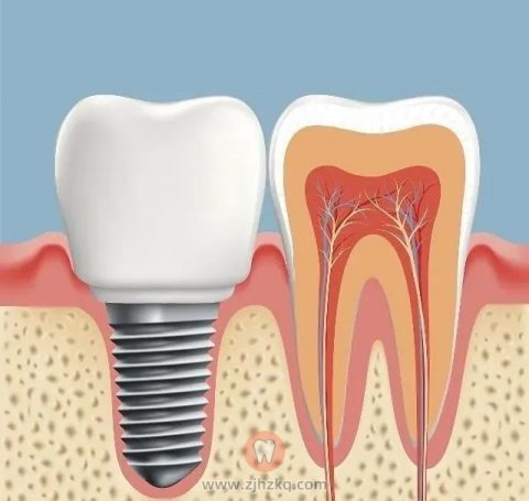种植牙与真牙之间的区别