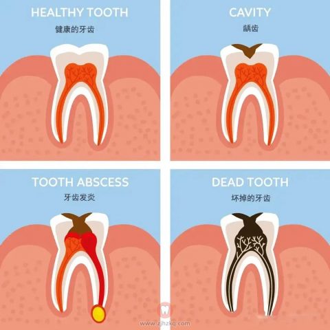 牙髓炎太痛苦了怎么预防才能不得牙髓炎