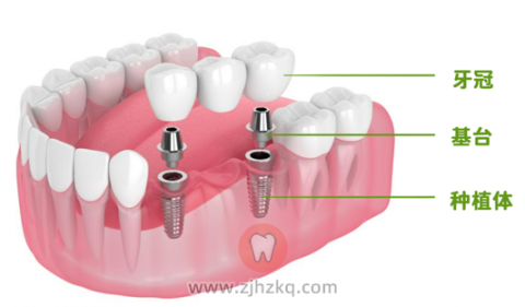 种植牙是什么对身体好不好