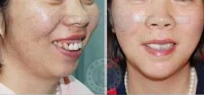 龅牙是不是遗传造成的