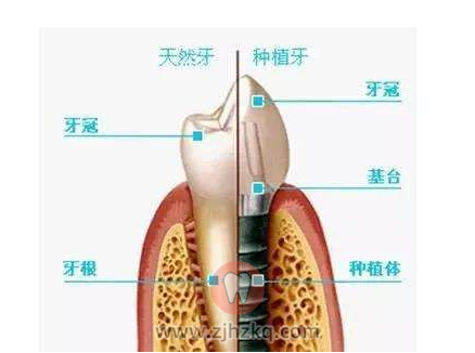 杭州种植牙的价格为什么高低差这么多