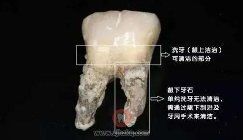 杭州哪些医院可以做牙周龈下刮治