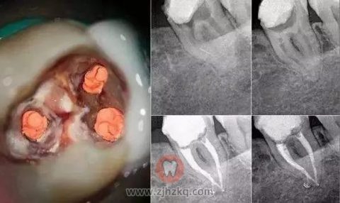 杭州根管治疗为什么那么贵牙医是不是在乱收费