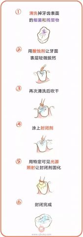 牙齿涂氟窝沟封闭是不是一样东西有什么区别