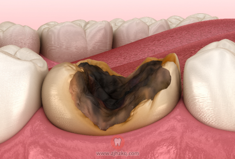 牙齿残根残冠图片