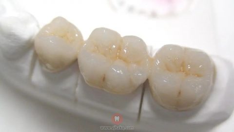 杭州做烤瓷牙的人多还是全瓷牙的人多
