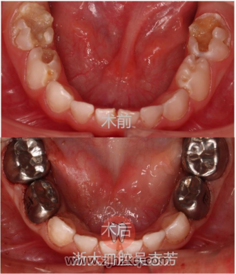 **口腔科普：儿童牙套有必要吗