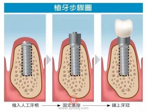 杭州种牙遇到疫情怎么办