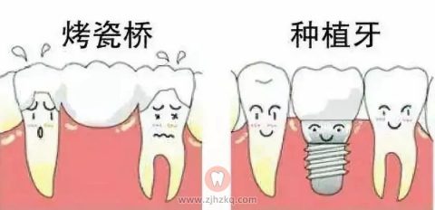 杭州种植牙和烤瓷牙哪个做的多