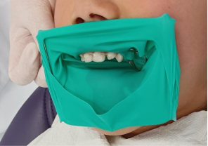 **口腔科普：儿童补牙时戴的“小雨伞”是什么