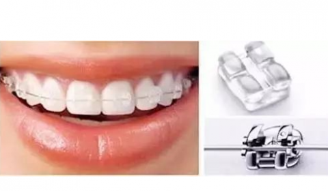 杭州牙齿矫正流程整理