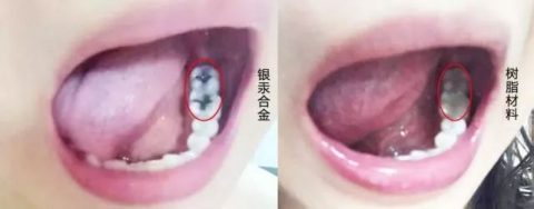 杭州银汞合金补牙是否靠谱