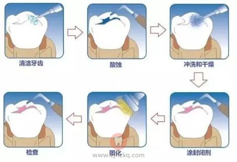 萧山瓜沥坚果口腔窝沟封闭过程科普