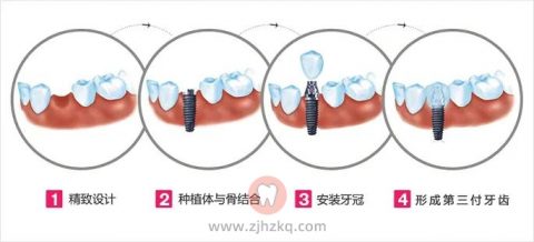 杭州种植牙的常见问题