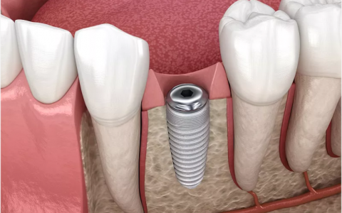 杭州种牙种植体品牌及价格大全最新整理版