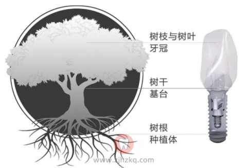 杭州瑞创口腔连锁缺失牙种植牙科普