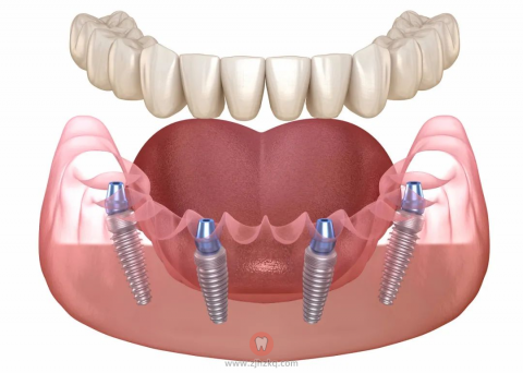 杭州摩耳口腔All-on-N种植牙介绍