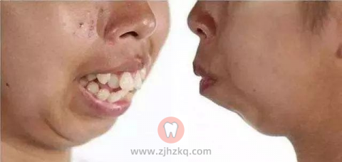 二十种必须要去医院矫正的牙齿畸形类型