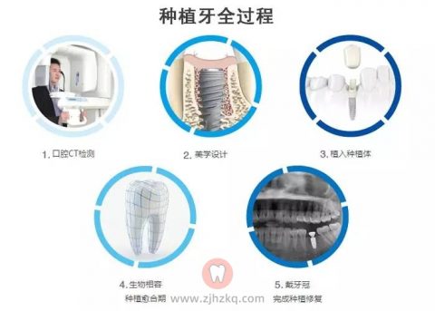 口腔医院科普种植牙