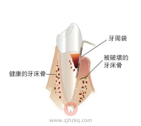 雅乐口腔余杭天都城店牙周病科普