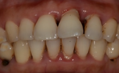 杭州口腔医院牙周炎种植牙看牙记