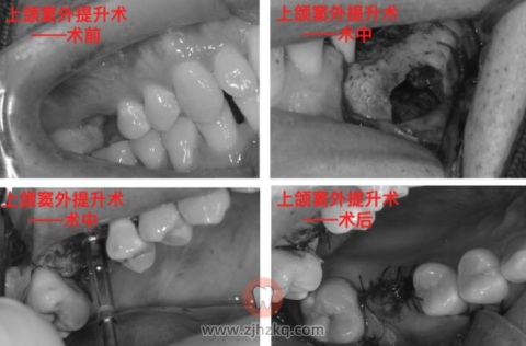 杭州口腔医院上颌窦外提升术植骨种牙记